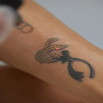 Laser Tattoo Removal Hialeah Gardens